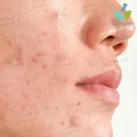 لوسیون ضد لک